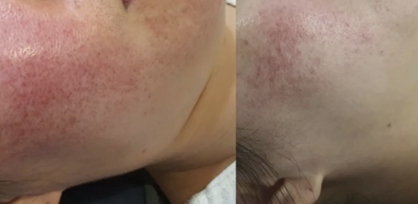 Before and after six facial sessions