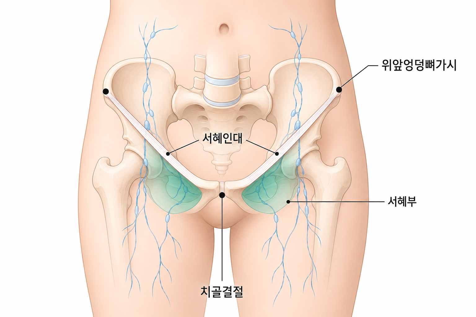 위앞엉덩뼈가시, 서혜인대, 치골결절과 서혜부 위치를 표시한 해부도