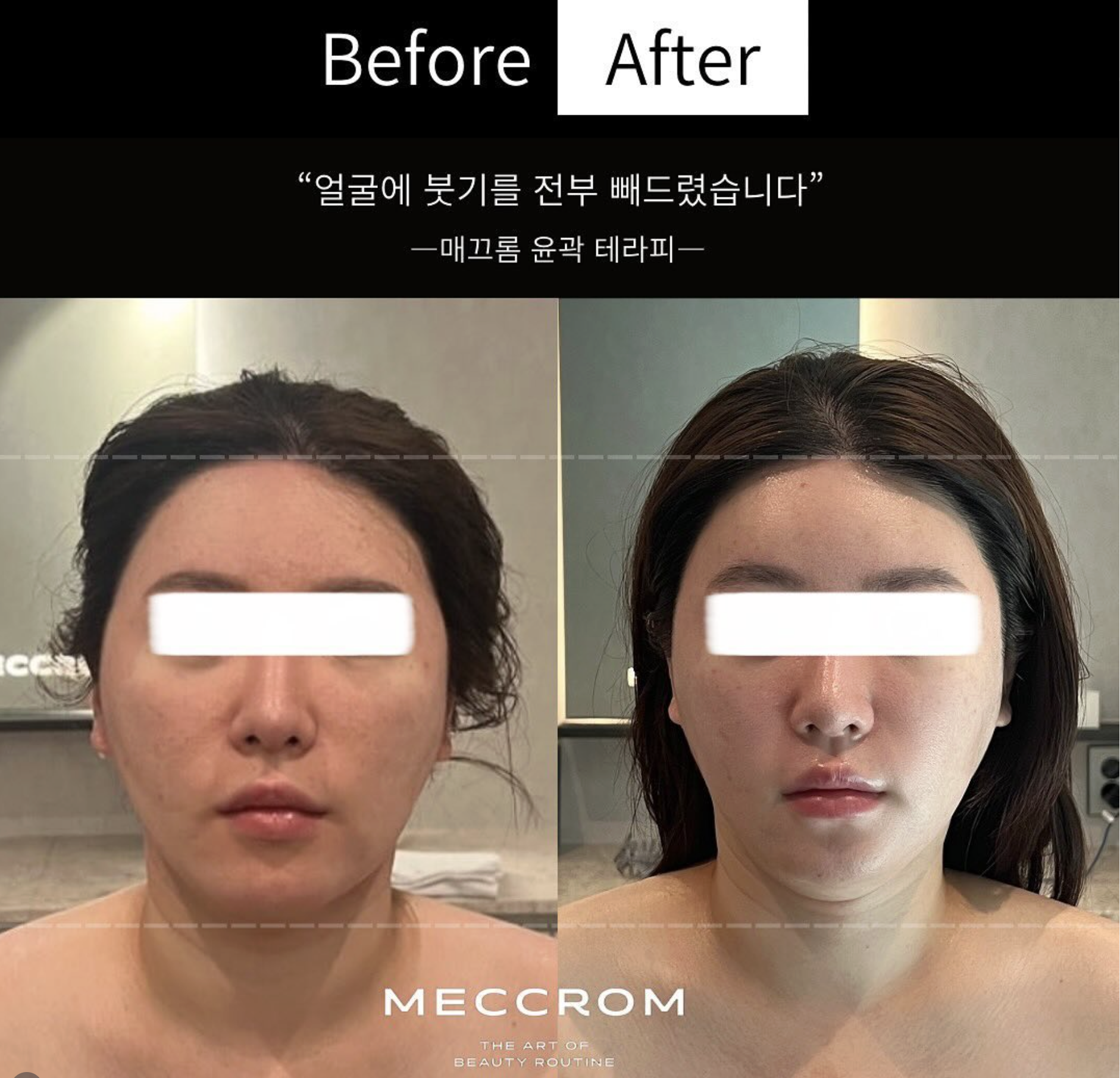 성형 후 에스테틱, 언제부터 받을까? 붓기 관리 원리와 수술별 프로그램
