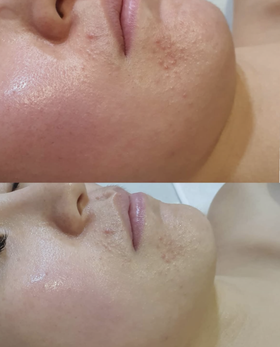 인천 트러블 피부관리 전과 관리 뒤 턱과 입 주변을 촬영한 비교 사진