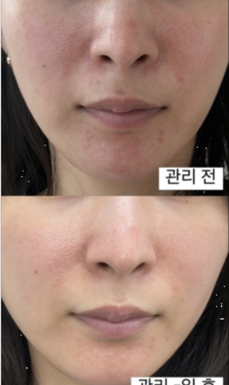 인천 웨딩 피부관리 전과 관리 뒤 얼굴 전체의 붉은 기와 피부결을 촬영한 비교 사진