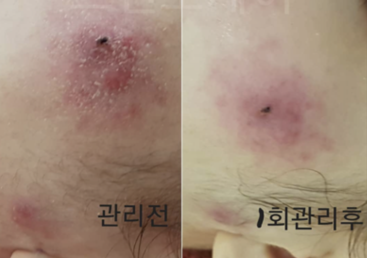 인천 여드름 피부 진정 케어 전과 1회 관리 후 광대 부근 트러블 비교 사진