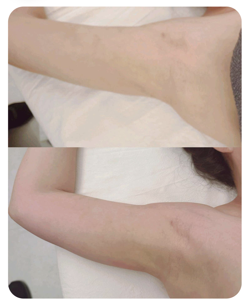 Arm photo provided by the customer with her post-liposuction care review
