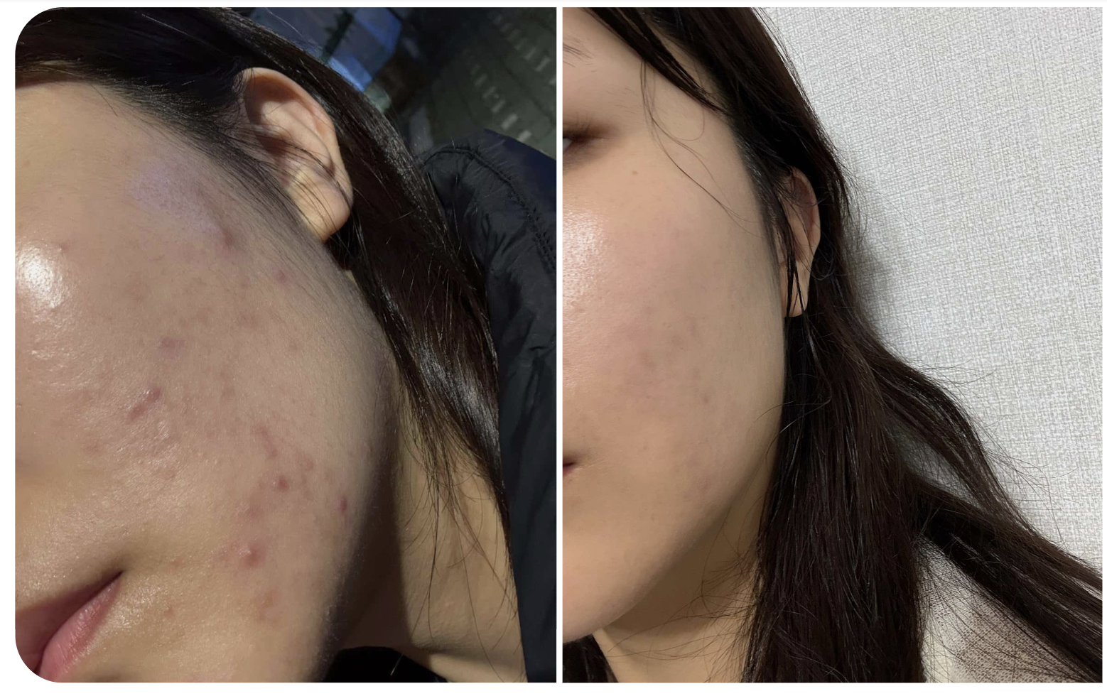 Two cheek photos provided by the customer with her skin care review