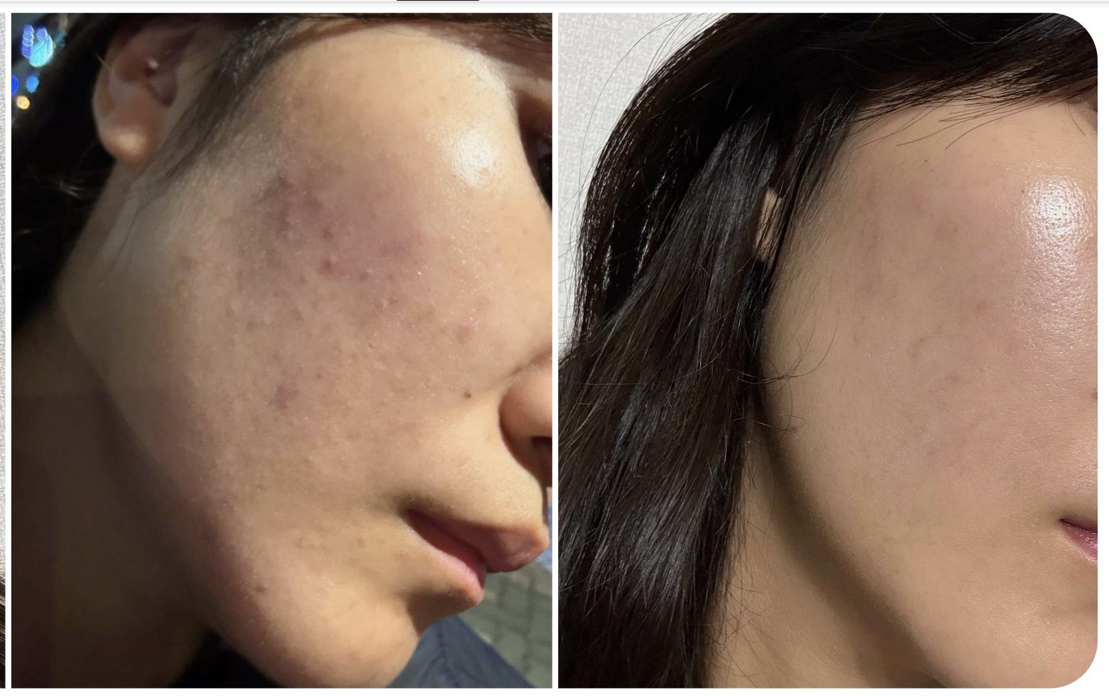 Photos of both cheeks provided by the customer with her skin care review
