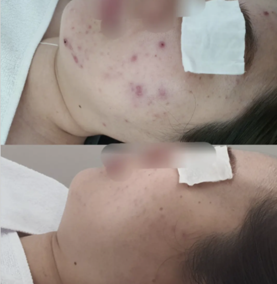 인천 피부관리 중 얼굴 트러블을 서로 다른 두 시점에 촬영한 비교 사진