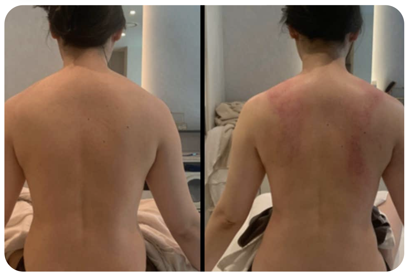 A waist and back comparison photo the customer labeled with the left side as before care
