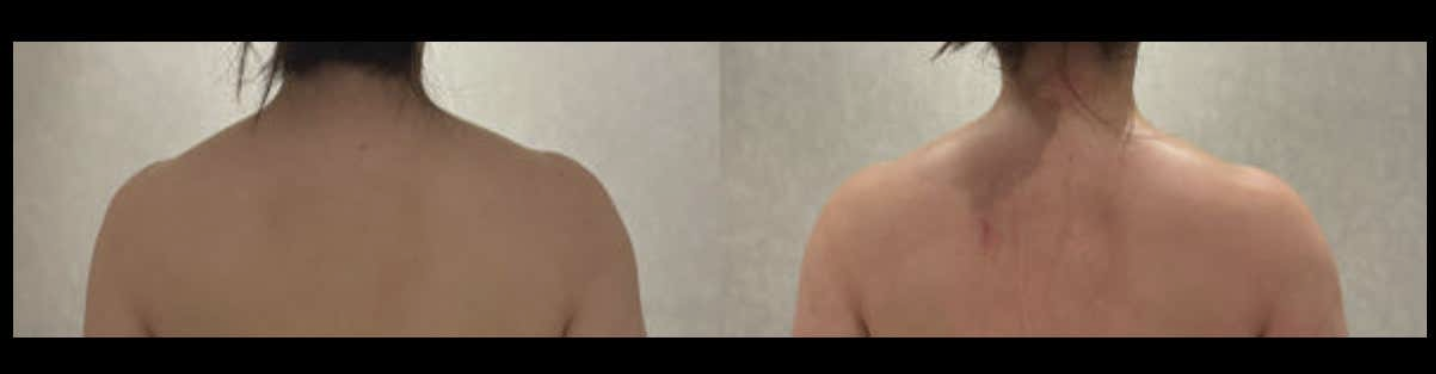 A back and shoulder comparison photo the customer said was taken after one session