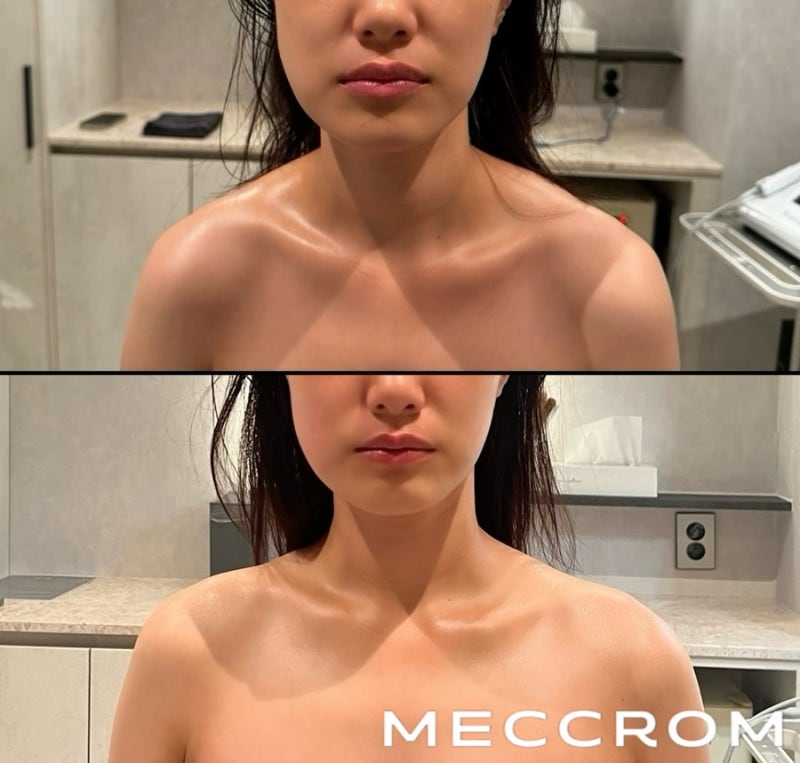 위쪽은 관리 전, 아래쪽은 관리 후로 기록된 한 고객님의 얼굴과 목, 어깨 비교 사진