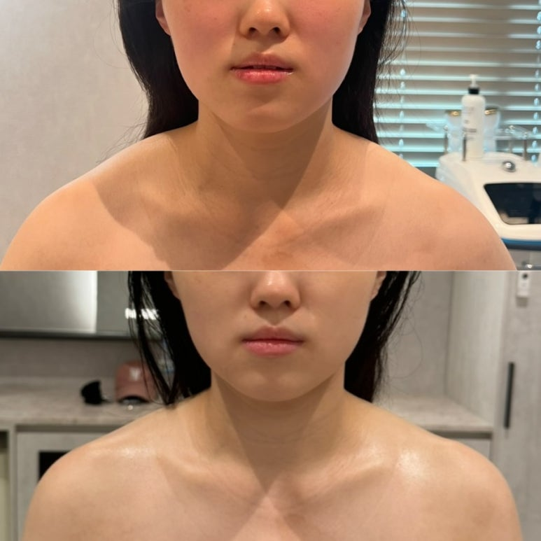 승모근 관리 전후 목선과 어깨선 비교
