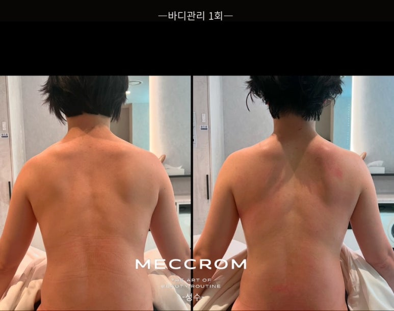 목과 어깨, 허리가 뻐근해 방문한 고객의 바디 관리 전후 비교