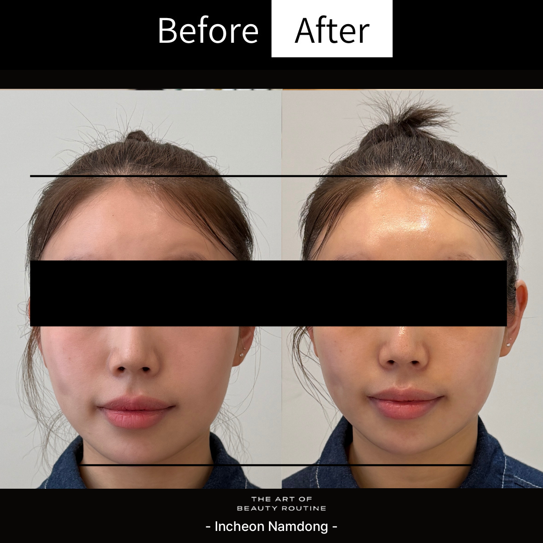 Before and after facial contour care for a Meccrom Incheon Namdong client
