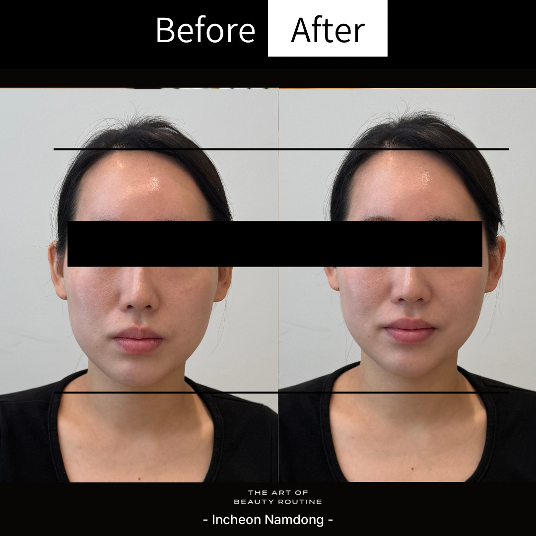 Before and after jawline and neckline care for a Meccrom Incheon Namdong client