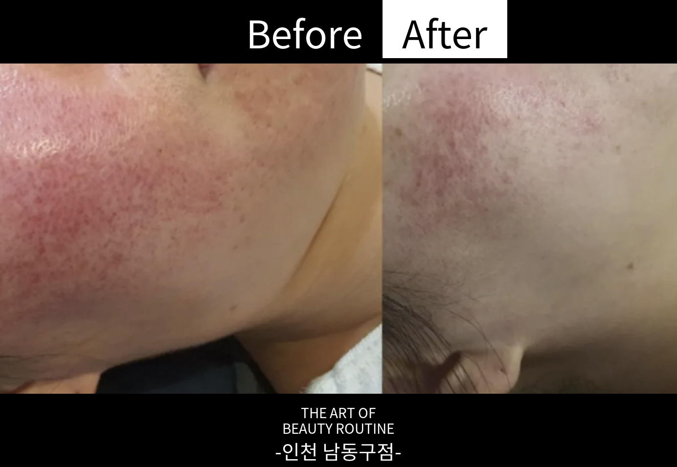 매끄롬 인천남동구점 고객의 관리 전과 6회 관리 후 뺨 비교
